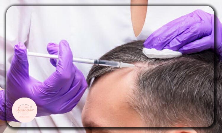 جلوگیری از ریزش مو با مزوتراپی و prp