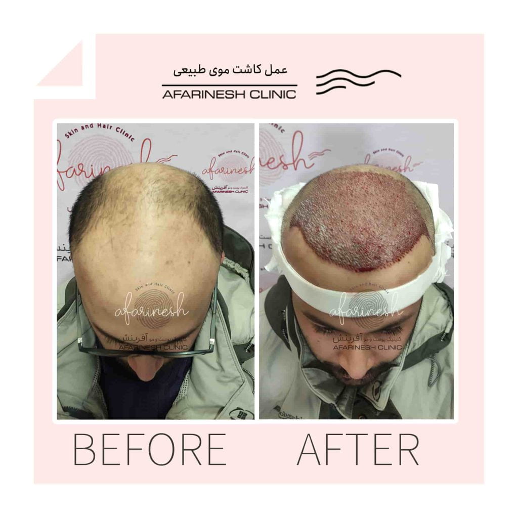 قبل و بعد از عمل کاشت مو