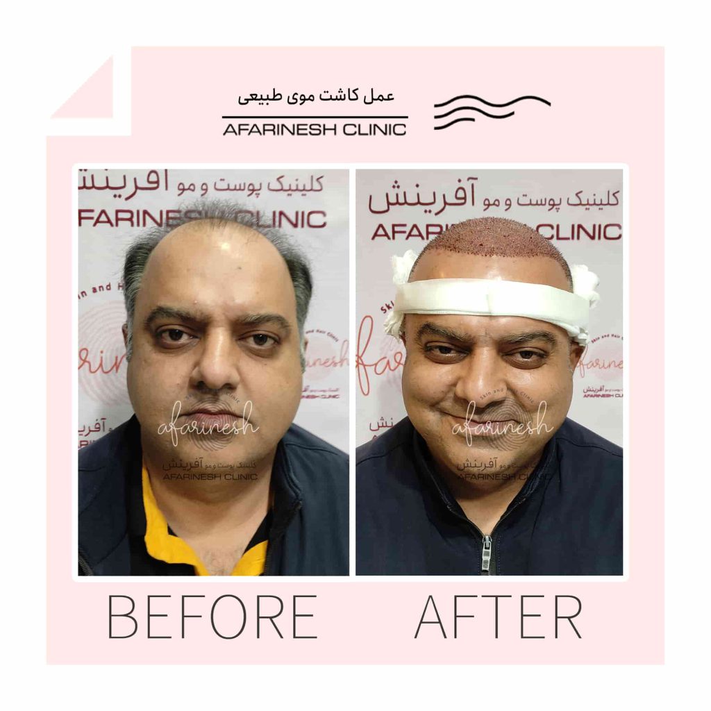 قبل و بعد از انجام کاشت مو
