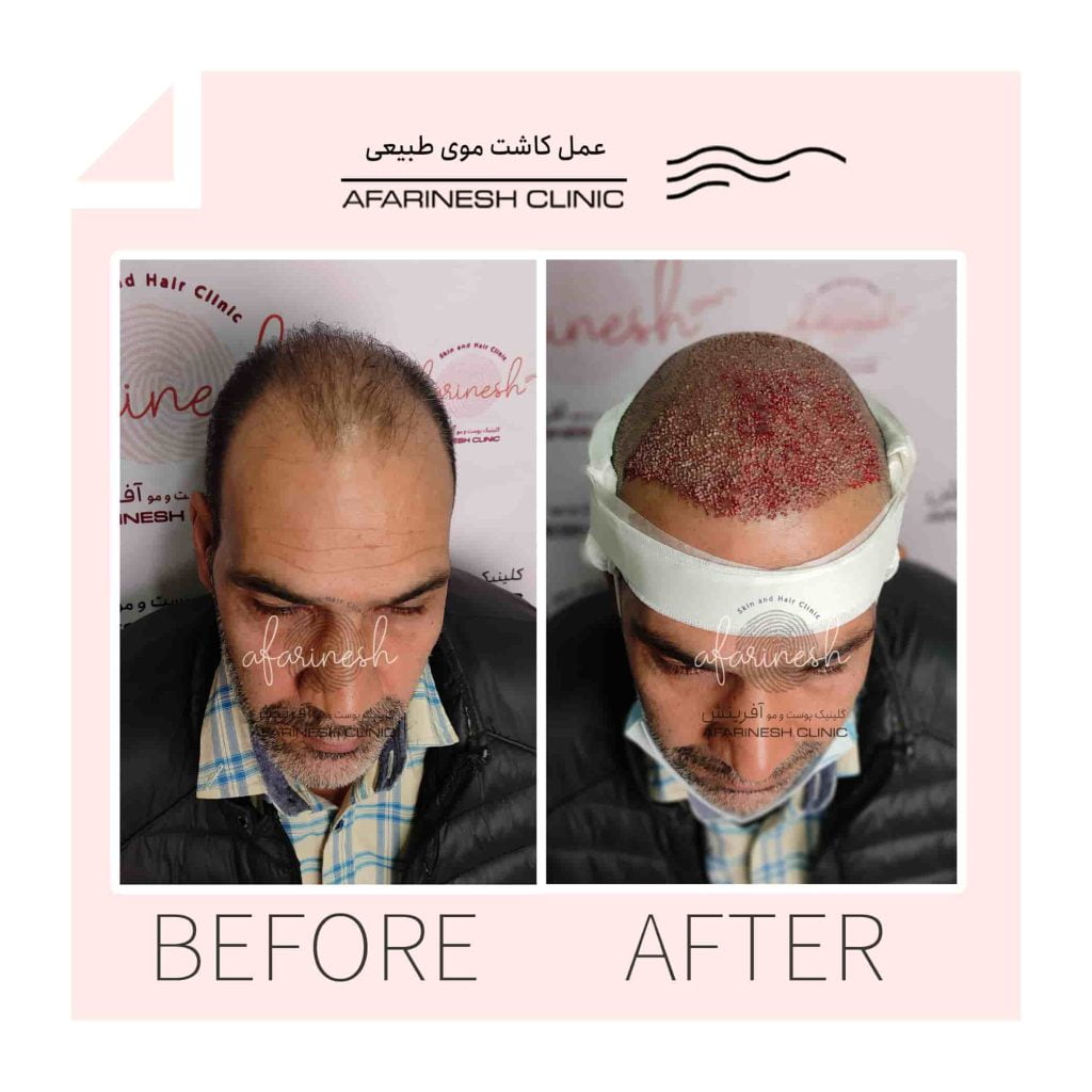 قبل و بعد از کاشت مو کلینیک