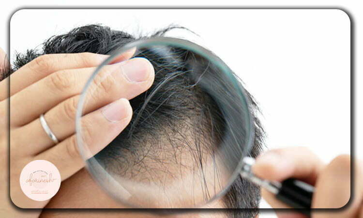 مراقبت از مو بعد از کاشت