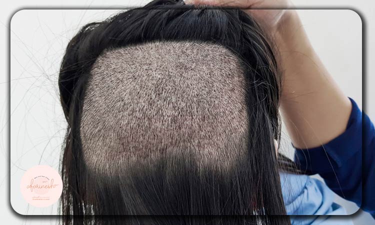 روش MicroFut در کاشت مو بانوان
