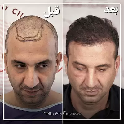 قبل و بعد کاشتن مو