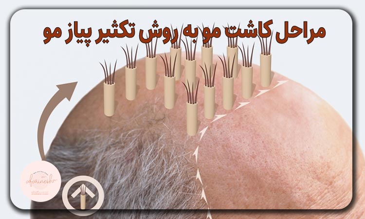 مراحل کاشت مو به روش تکثیر پیاز مو